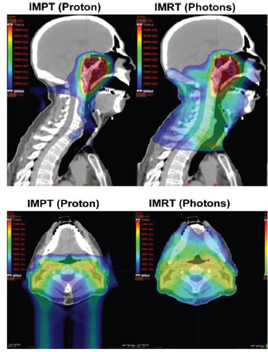 impt vs imrt