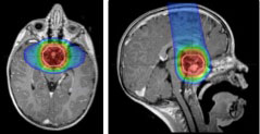 Proton therapy for a craniopharyngioma