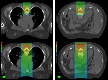 Cross-sectional view of a medulloblastoma patient undergoing proton craniospinal irradiation (CSI) (top) and X-ray craniospinal radiation (CSI) (bottom).