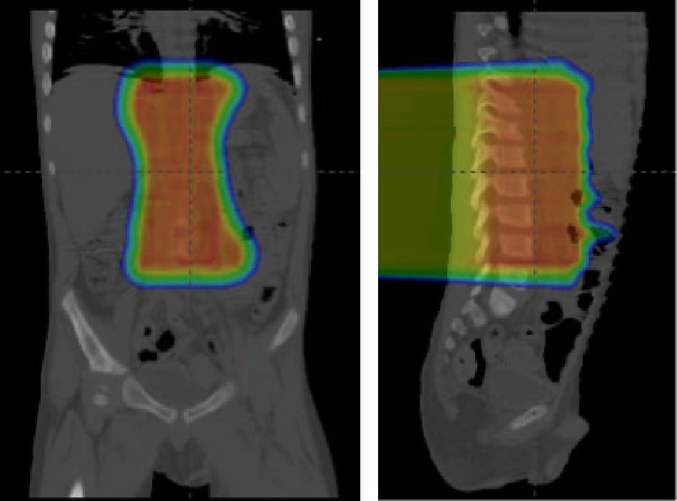 Proton therapy for a neuroblastoma