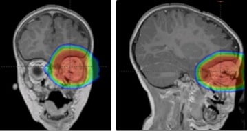 Proton therapy for a retinoblastoma