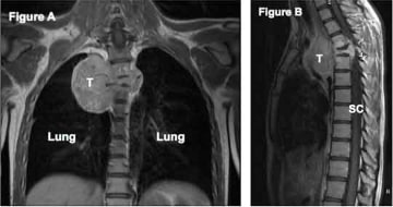 image of a sarcoma of the spine in the front view (Figure A) and side view (Figure B)