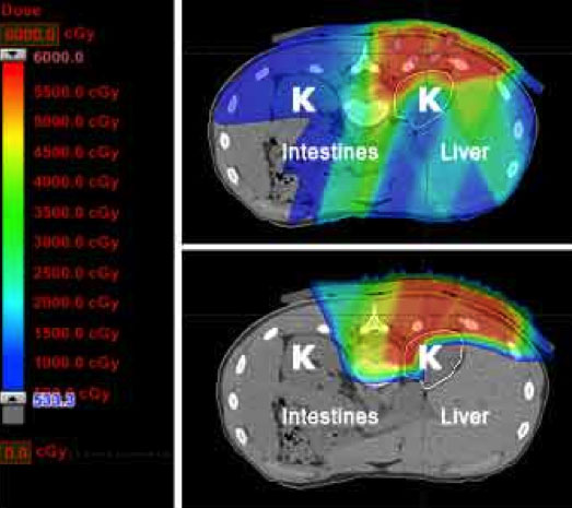 Dose distribution comparison between conventional photon radiation plan (top) and a proton therapy plan (bottom) in a young patient with a Ewing sarcoma adjacent to the spine